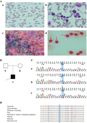 A novel and apparent de novo ALAS2 missense variant associated with congenital sideroblastic anemia